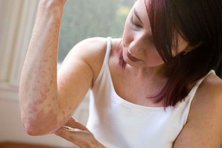 Eczema Sufferers Best Way to Use Skin Care for Eczema Sufferers 